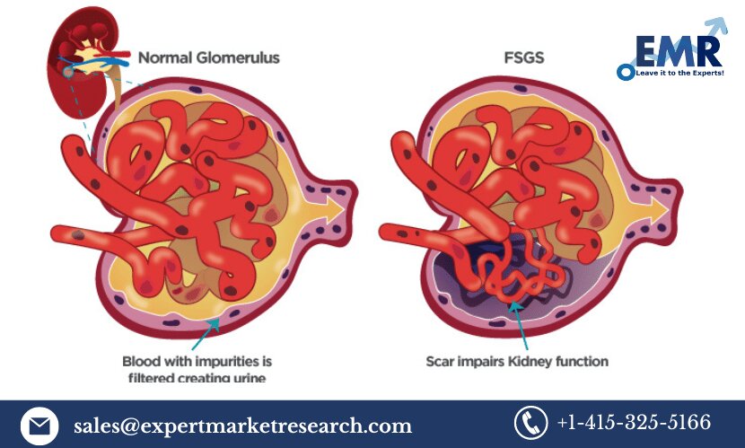 Focal Segmental Glomerulosclerosis (FSGS) Treatment Market